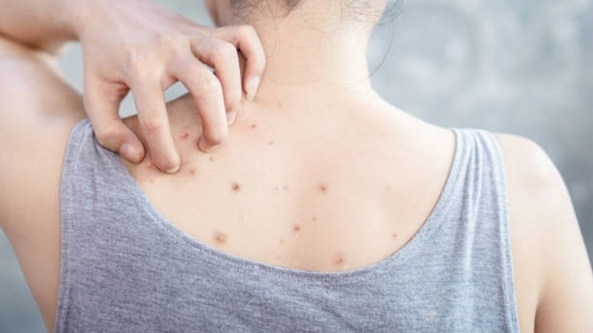Tiga Spray Jerawat Punggung Bantu Rawat Kulit Berjerawat